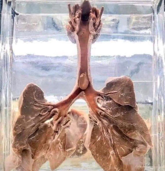 A peanut lodged inside a child's trachea!!⁣ 
