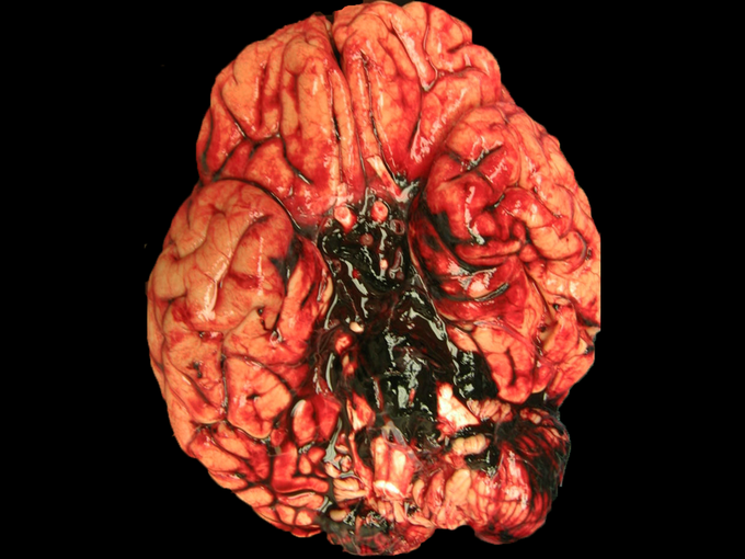 Associations of Berry Aneurysm