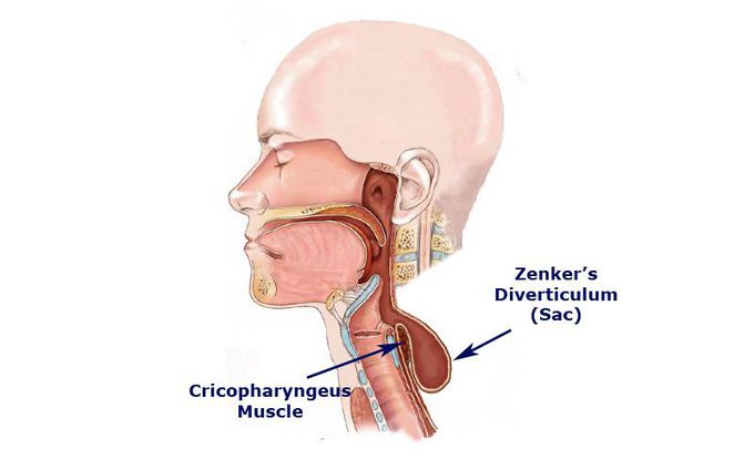 What are symptoms of Zenker’s diverticulum?