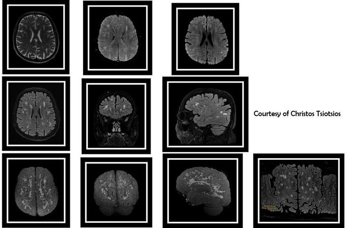 MR Imaging of chronic microvascular ischemic disease