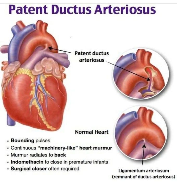 Patent Ductus Arteriosus