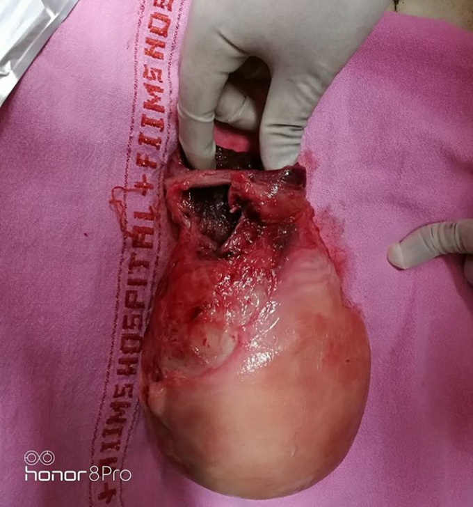 Uterine Rupture