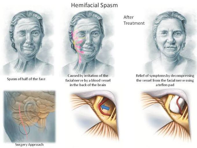 Hemifacial spasm