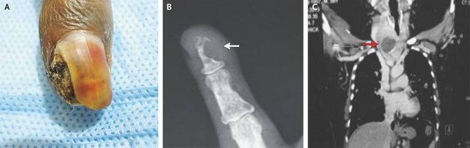 Metastasis from Thyroid Carcinoma
