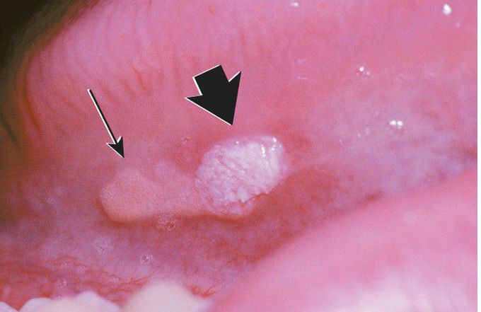 Verruciform Xanthoma.