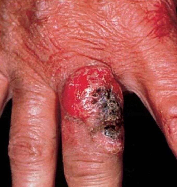 A 62-year-old man presents with an ulcerated, encrusted, and infiltrating lesion on the sun-exposed dorsal aspect of a finger (shown in the image). A biopsy reveals squamous cell carcinoma. The metastatic potential of this neoplasm would be enhanced by upregulation of the gene for which of the following proteins?
1. Collagen type IV
2. Desmin
3. E-cadherin
4. Glutathione peroxidase
5. Plasminogen activator.                                                 Source ;medicmad