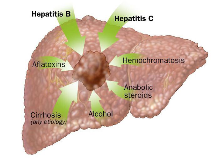 Most chances of liver cancer
