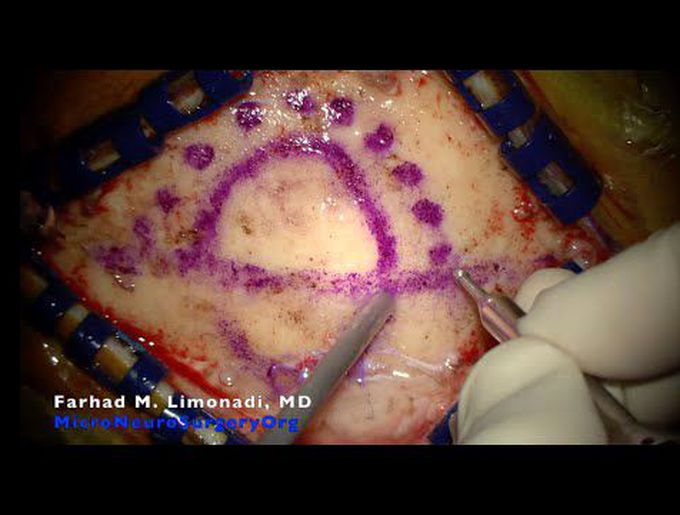 Keyhole Brain Surgery. Falcine parietal brain tumor removed displaying keyhole principles:Meningioma
