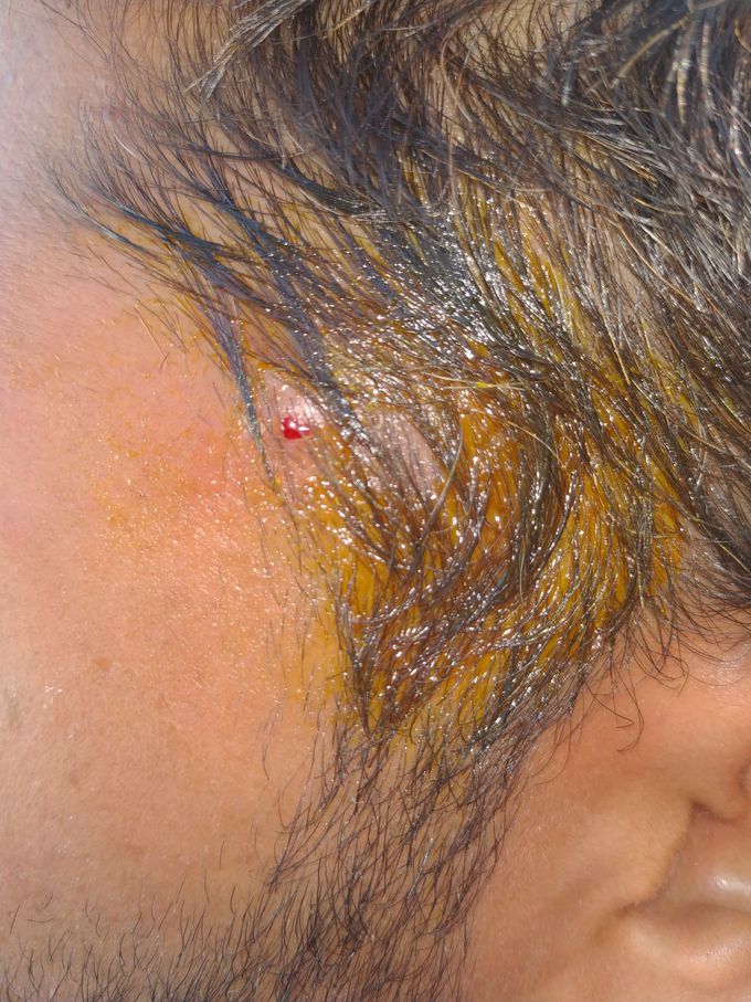 Skin condition