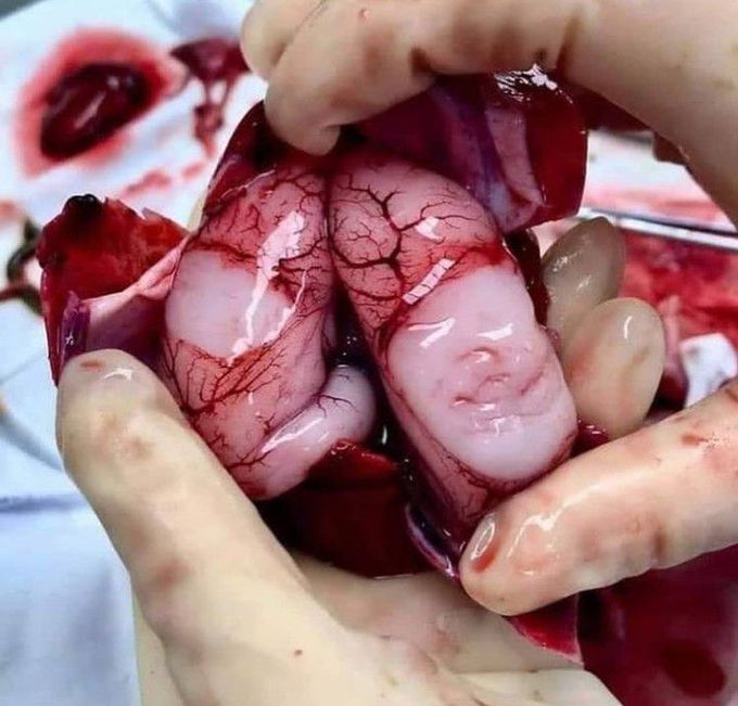 Fetal Brain
