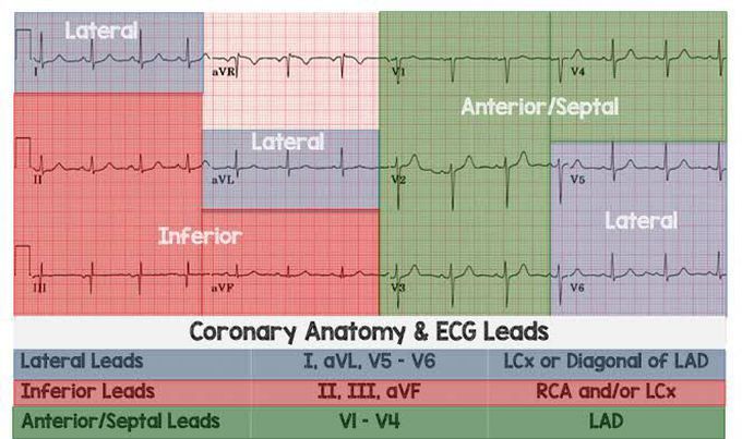 ECG localisation of STEMI