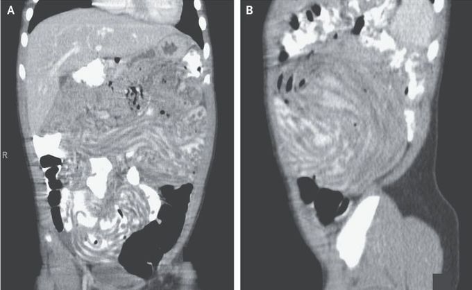 Tubular Opacities in the Gastrointestinal Tract