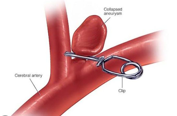 Treatment for Brain Aneurysm