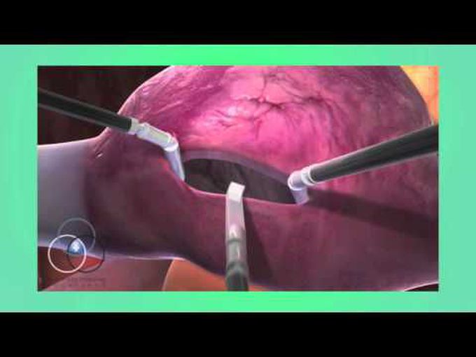Robotic Atrial Septal Repair - Animated