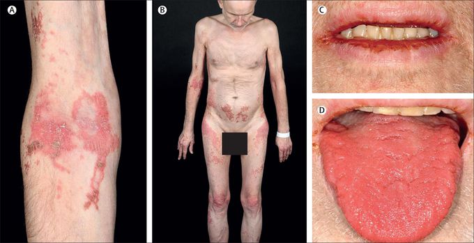 Symptoms of glucagonoma