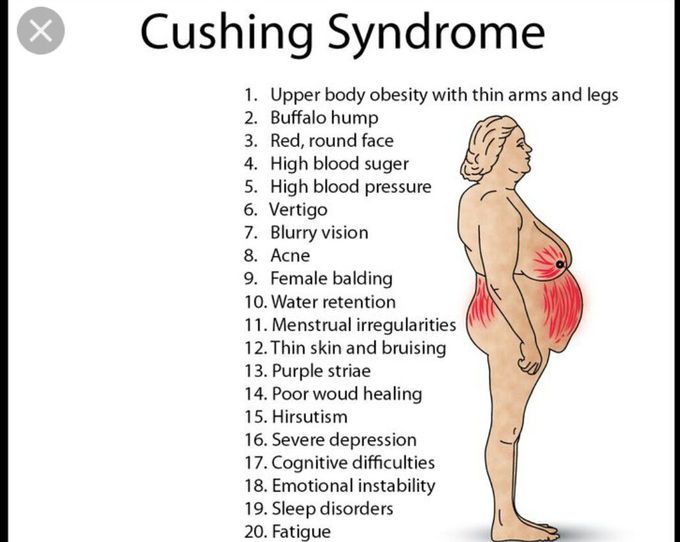 Cushing syndrome