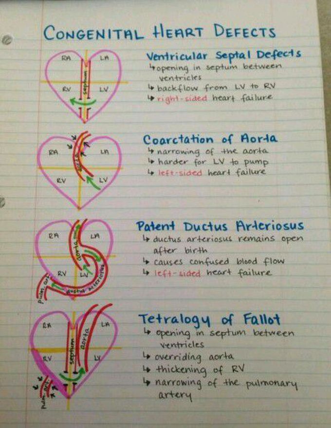 Congenital Heart Defects