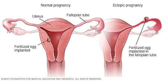 Symptoms of ectopic pregnancy