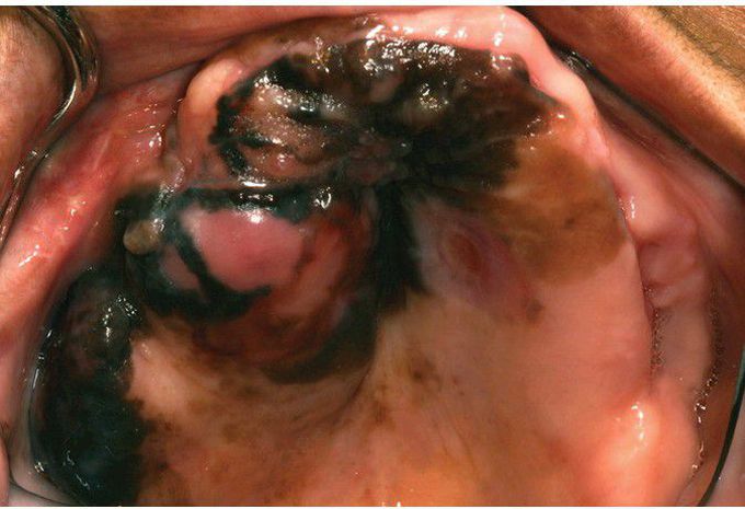 Oral Melanoma