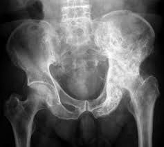 Symptoms of pagets disease