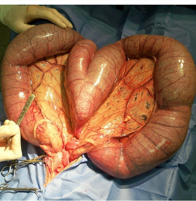Uterine infection surgery