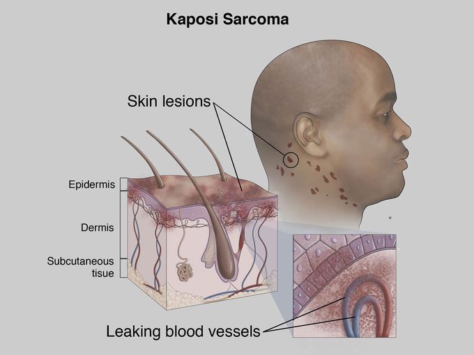 Kaposi sarcoma