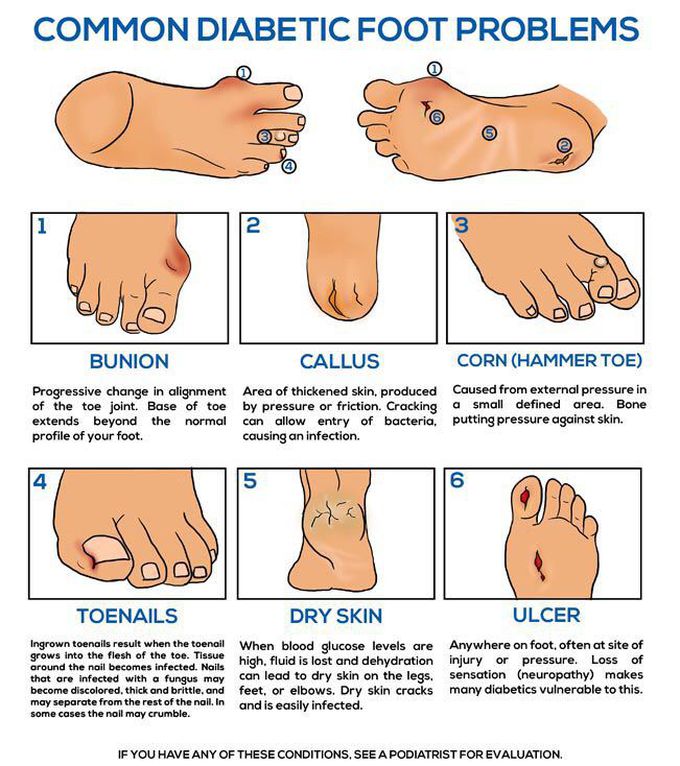 Common diabetic foot problem