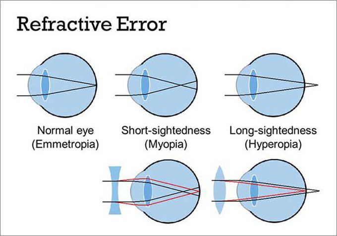 Causes of Refractive errors