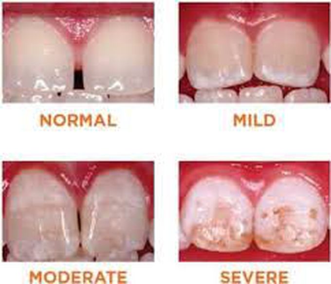 Enamel hypolpasia