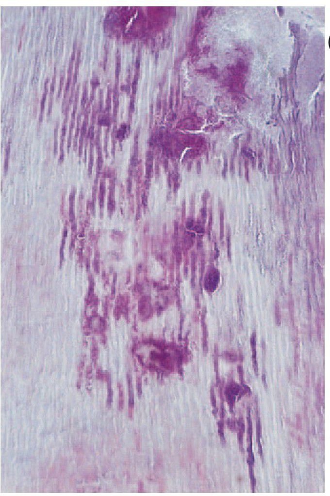 Caries of dentine