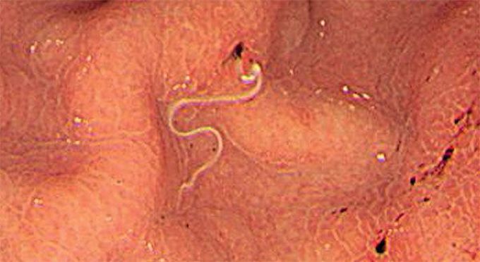 Abdominal pain after eating a meal of sushi