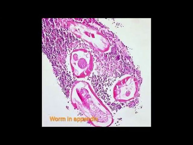 Enterobiasis- causative agent, clinical, diagnosis and treatment