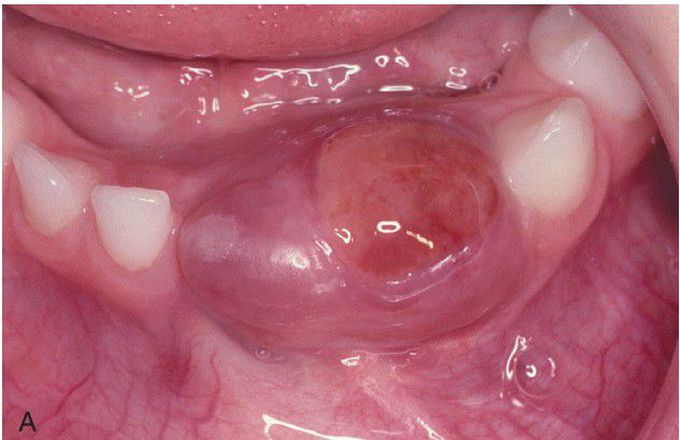 Central Giant Cell Granuloma