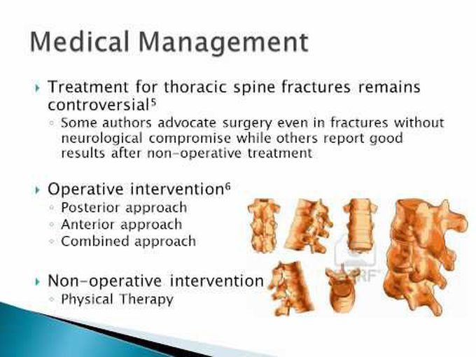 Thoracic Spine Fractures: Overview