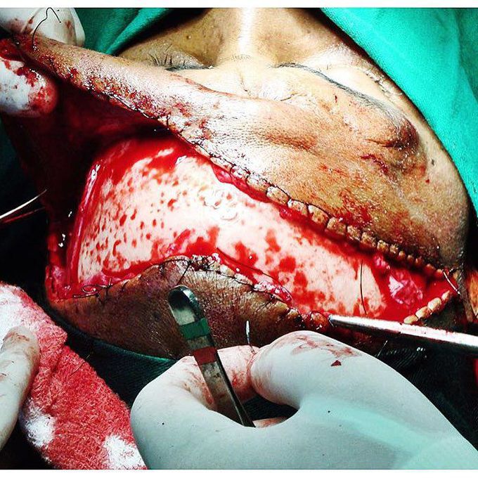 Coronal approach to the upper facial skeleton