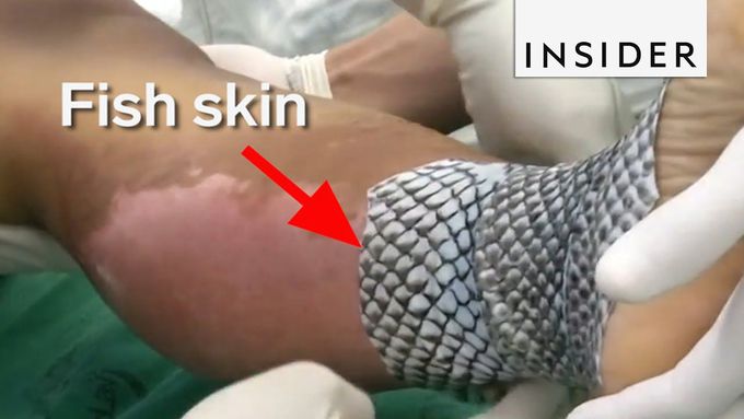 Doctors Are Using Fish Skin to Treat Burns