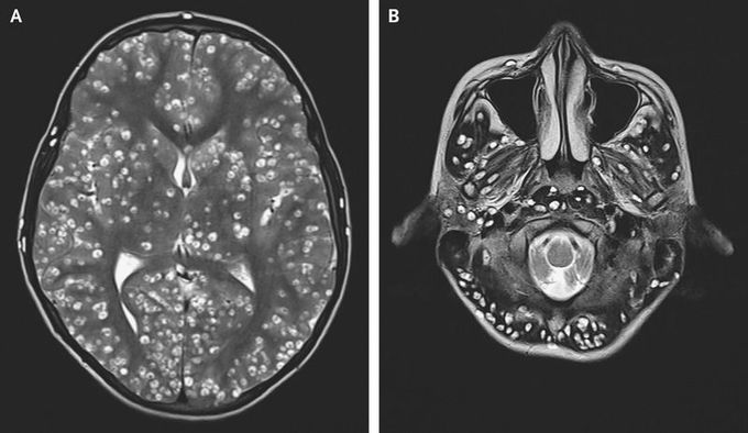 Disseminated Cysticercosis