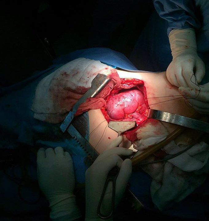 Renal transplantation in process!  