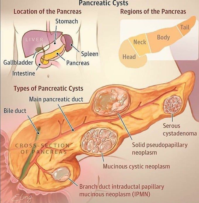 Pancreatic Cysts