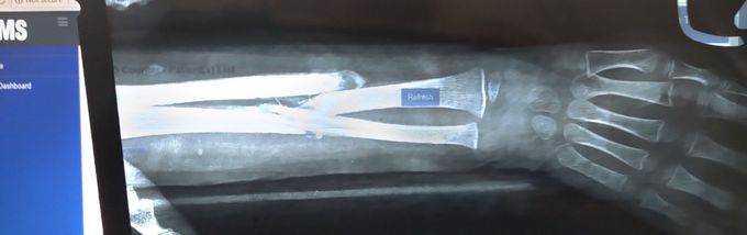 Fracture Radius + Ulna