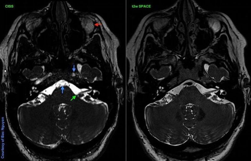 ボールガイ　mri hqdefault.jpg