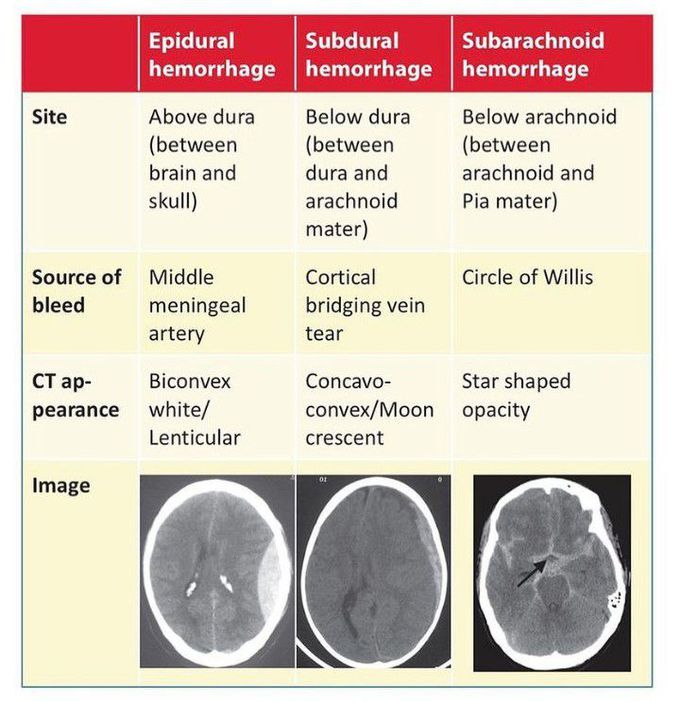 Types of intracranial bleeding