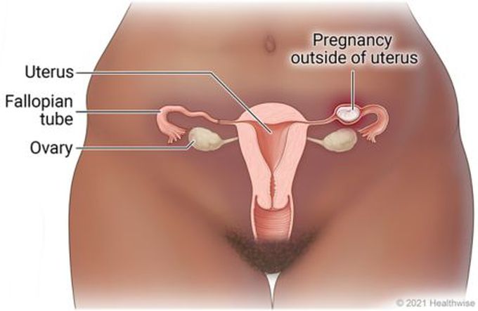 Where does an ectopic pregnancy happen?