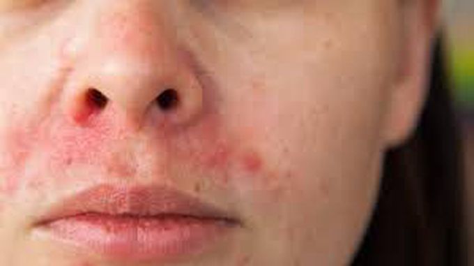 Cause of perioral dermatitis