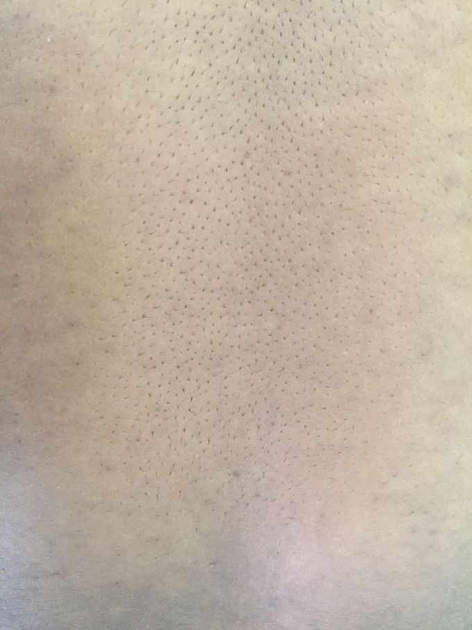 Severe back pain