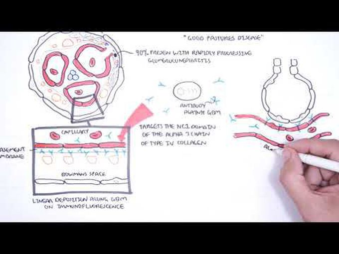 Kidney Diseases IV-
Nephritic syndrome