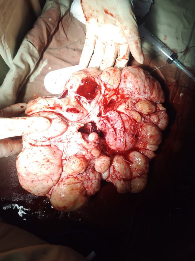 Fibroid Uterus