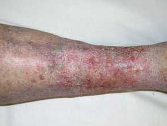 Varicose eczema