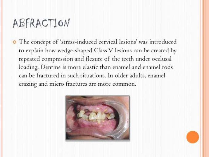 Abfraction