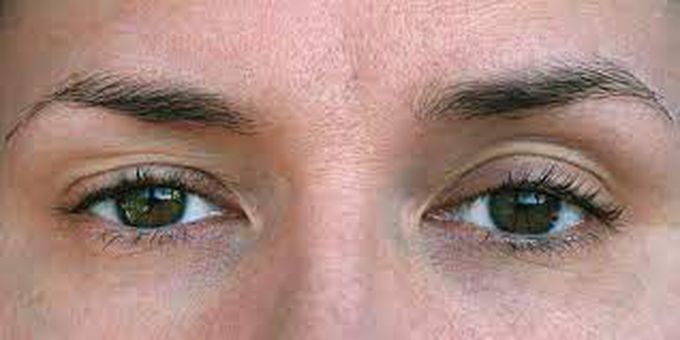 Ptosis (Droopy Eyelid)